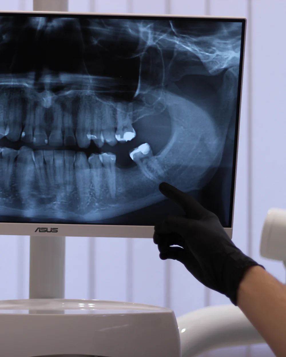A gloved hand pointing at a panoramic dental X-ray on screen.